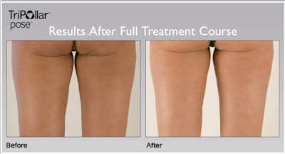 Tripollar Pose Before and After Photos showing results on cellulite